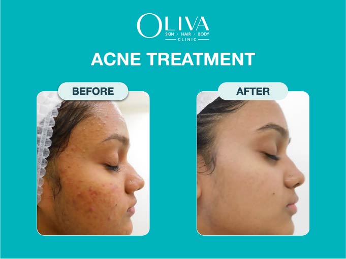 Oliva Skin, Hair & Body Clinic - Ludhiana - Oliva Skin, Hair & Body Clinic - Ludhiana No 67-D, nearby Garden Cafe, D-Block, Sarabha Nagar, Ludhiana, Punjab 141001, India