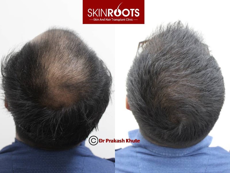 Dr Prakash Khute, MD (AIIMS, New Delhi)- Best skin specialist in Raipur| Dermatologist| Hair transplant| Lasers| PRP - Dr Prakash Khute, MD (AIIMS, New Delhi)- Best skin specialist in Raipur| Dermatologist| Hair transplant| Lasers| PRP, 25th avenue, near Lotus electronic store, Sector 1, Shankar Nagar, Raipur, Chhattisgarh 492004, India