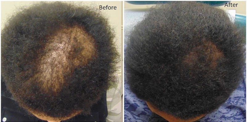 Arogya Clinic Skin and Hair clinic In Gurgaon PRP Treatment - Laser Treatment - Skin Specialist - Arogya Clinic Skin and Hair clinic In Gurgaon PRP Treatment - Laser Treatment - Skin Specialist opposite payal cinema, Prem Nagar, Rajiv Nagar, Sector 14, Gurugram, Haryana 122007, India