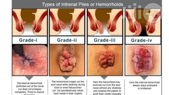 Jani clinic - Advance Piles,Fissure,fistul Treatment centre - Jani clinic - Advance Piles,Fissure,fistul Treatment centre, Shop no. 3 OMKAR BUILDING , jaku club ,menejis wadi, 9th, Prabhat Colony Rd, opposite railway station, Sen Nagar, Santacruz East, Mumbai, Maharashtra 400055, India