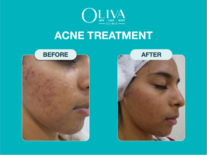 Oliva Skin, Hair & Laser Clinic Kalyani Nagar, Pune: Laser Hair Removal, Acne Scar, PRP, Hair Loss, Skin Whitening Treatments