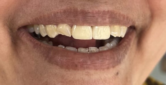 Citrus Dental - Invisalign Provider - Citrus Dental - Invisalign Provider 06, 1st Cross Rd, opposite Chrysalis High, Gunjur Village, Bengaluru, Karnataka 560087, India