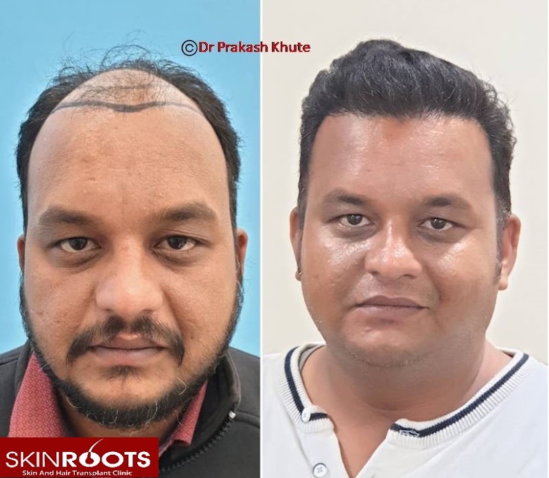 Dr Prakash Khute, MD (AIIMS, New Delhi)- Best skin specialist in Raipur| Dermatologist| Hair transplant| Lasers| PRP - Dr Prakash Khute, MD (AIIMS, New Delhi)- Best skin specialist in Raipur| Dermatologist| Hair transplant| Lasers| PRP, 25th avenue, near Lotus electronic store, Sector 1, Shankar Nagar, Raipur, Chhattisgarh 492004, India