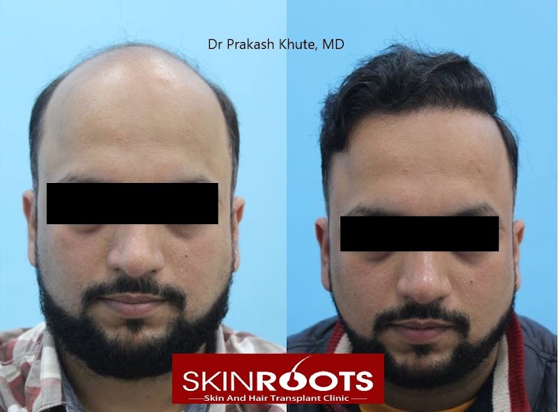 Dr Prakash Khute, MD (AIIMS, New Delhi)- Best skin specialist in Raipur| Dermatologist| Hair transplant| Lasers| PRP - Dr Prakash Khute, MD (AIIMS, New Delhi)- Best skin specialist in Raipur| Dermatologist| Hair transplant| Lasers| PRP, 25th avenue, near Lotus electronic store, Sector 1, Shankar Nagar, Raipur, Chhattisgarh 492004, India